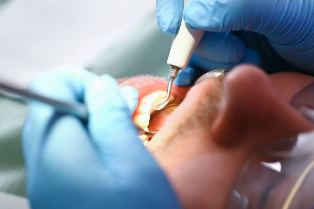 Best Emergency Tooth Extraction in Cambridge, WI